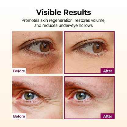 Smooth Deep Wrinkles Instantly Without Painful Clinic Injections