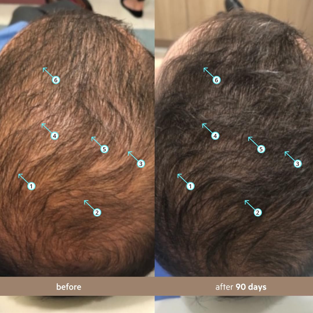 Regain Your Crown: The Science-Backed Breakthrough for Thicker, Fuller Hair.
