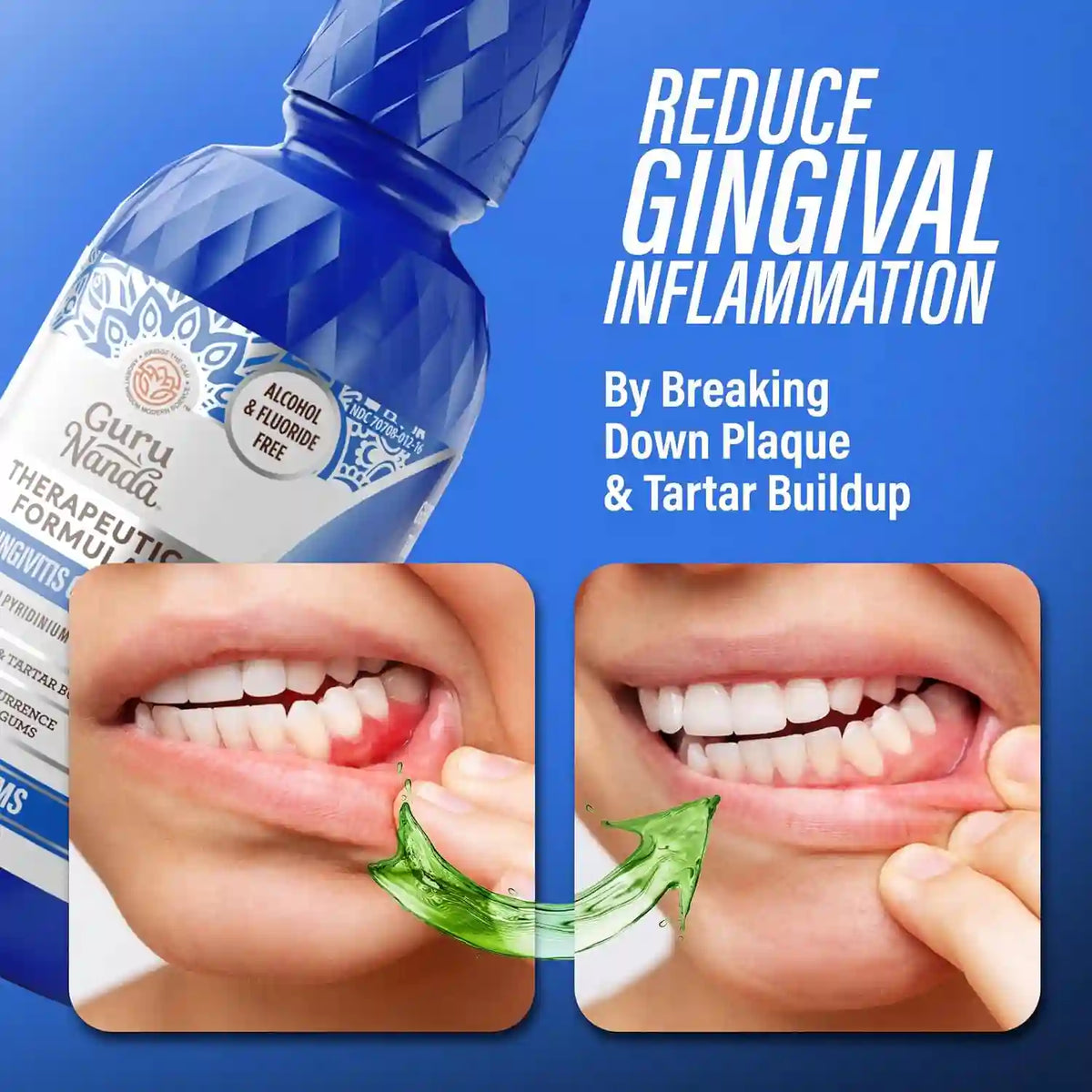 Healthy Gums Mouthwash – 0.05% CPC Anti-Gingivitis Formula For Healthy Gums & Zero Bleeding