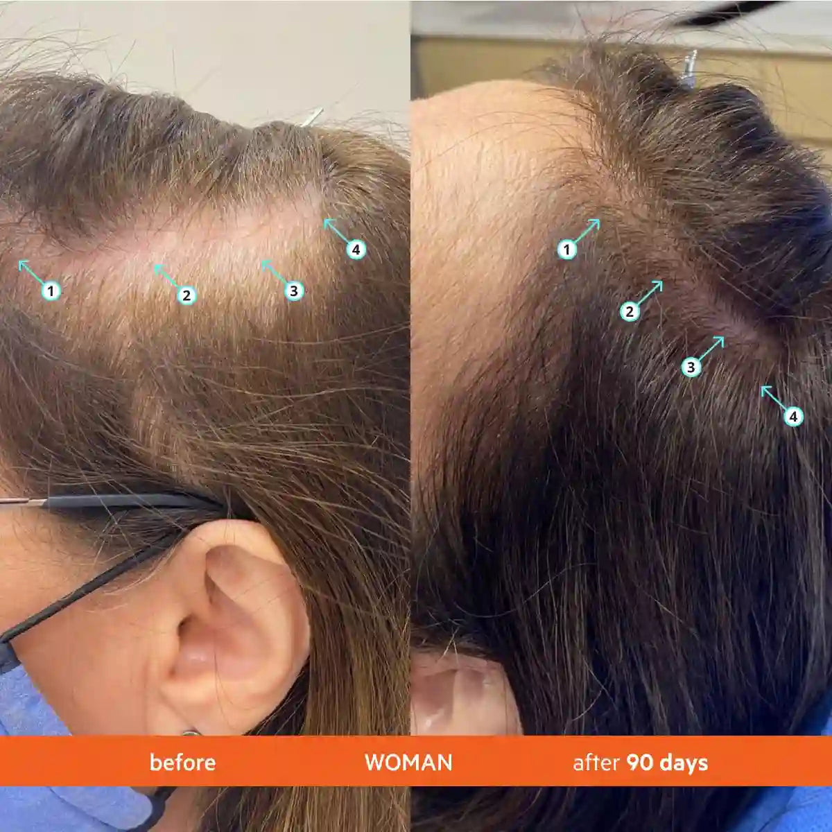 Hair Density Shampoo – 21+ Bio-Active Nutrient Delivery For Thicker, Fuller-Looking Hair