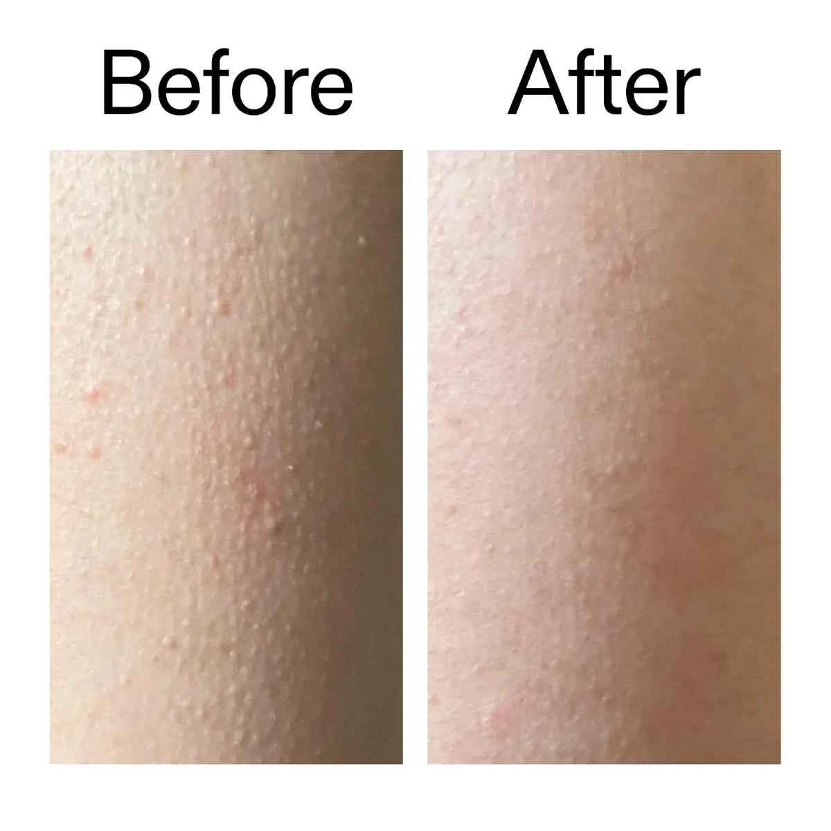Glycolic Acid Exfoliating Body Stick – Easy-Glide AHA Formula For Smooth, Bump-Free Skin